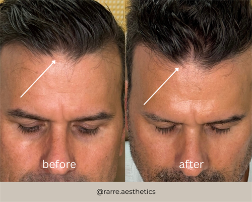 Before and After Hair Restoration using ULTRA+ and Plant-Based Exosomes