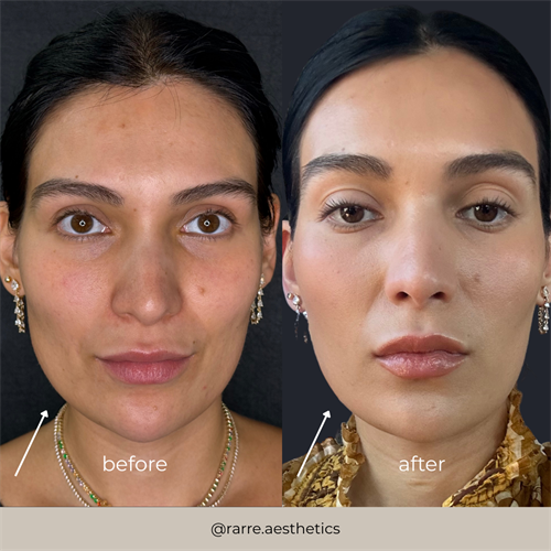 Before and After First Masseter Tox Treatment