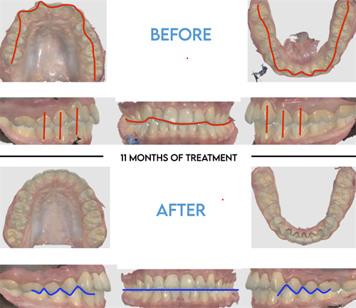 Before/After with Lines