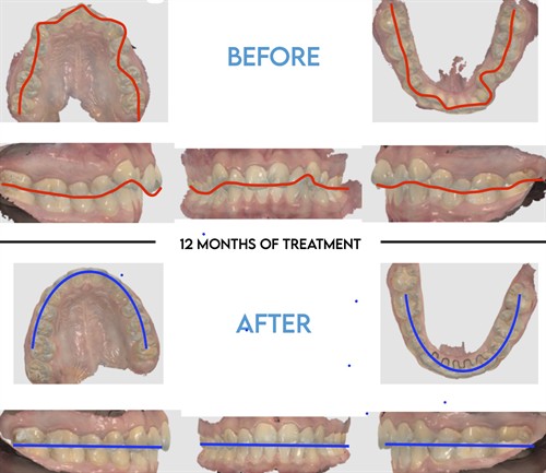 Before/After 2 with Lines
