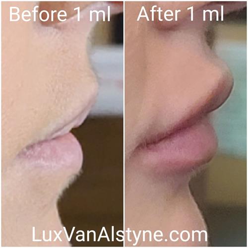 Dermal Lip Fillers provide subtle correction. Natural and Beautiful. 