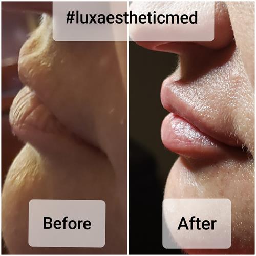 Projection of the lips is returned with volume replacement.
