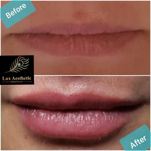 We specialize in natural looking lip treatments. 