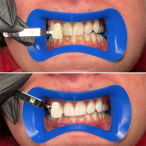 Teeth Whitening