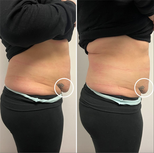 Body Sculpting - Skin Tightening