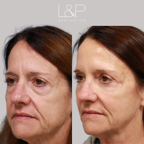 Before and After - Lower Blepharoplasty