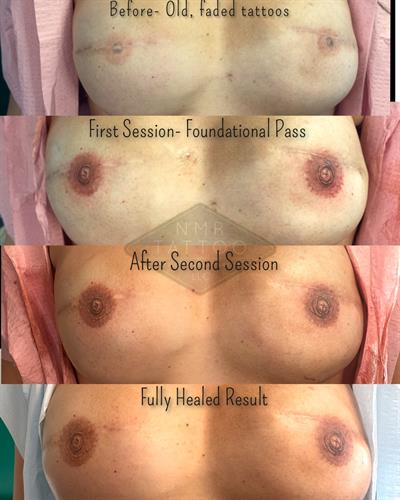 3d Nipple tattoo correction - Breast Cancer tattoo
