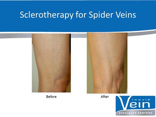 Varicose Veins Signs and Symptoms - Inovia Vein Specialty Center