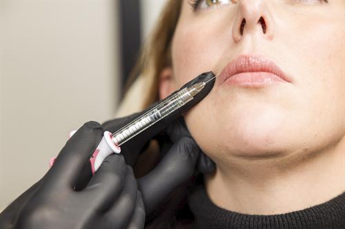 Lip Filler