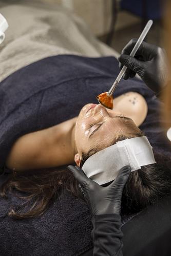 Chemical Peels