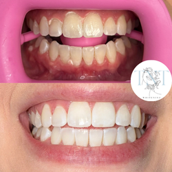 Teeth Whitening