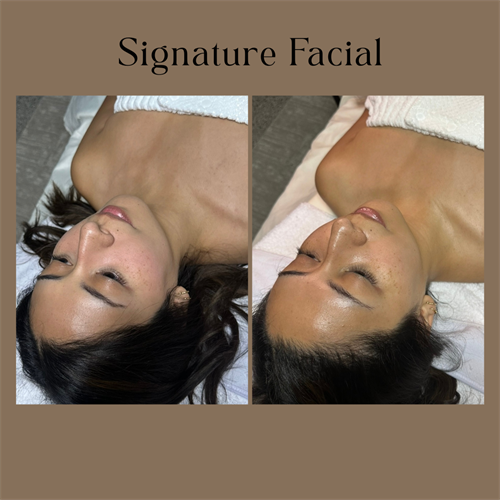 Before & After a Signature Facial
