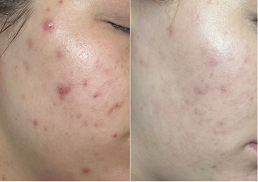 Acne Treatments with Smart Chemical Peels