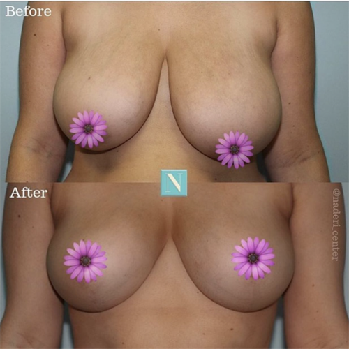Breast lift by Dr. Anderson. Asymmetry was also addressed to give this patient the perky breasts that she desired.