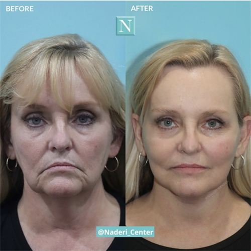 Facelift, necklift, and lip injections by Dr. Kulak. This middle-aged, Caucasian patient looks like a younger, refreshed version of herself. The definition of aging gracefully.