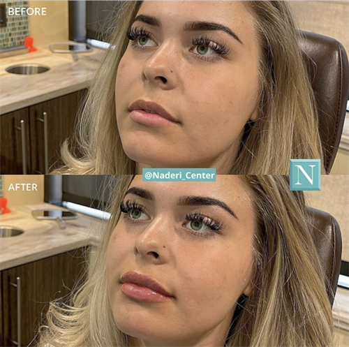 Lip injections by Dr. Snodgrass. She injected 1 syringe of Juvederm Ultra to add volume and symmetry to the patient's lips.