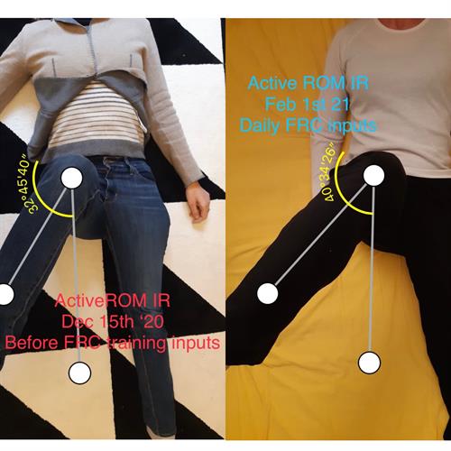 Hip Internal rotation progress 
