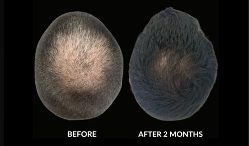 PRP to stimulate hair regrowth 