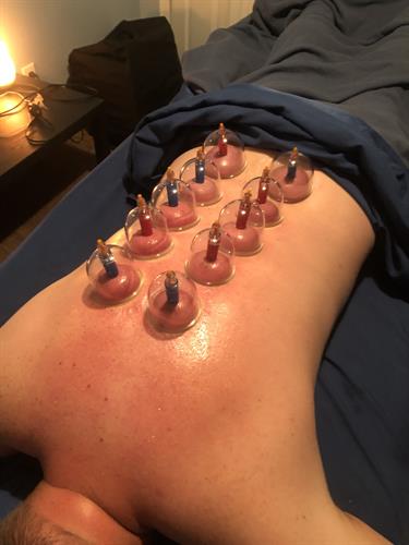 Cupping Therapy