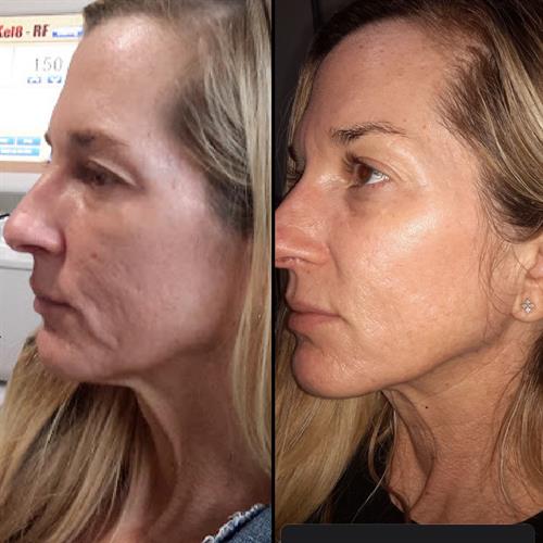 Rf Microneedling before and after for scarring and skin tightening 