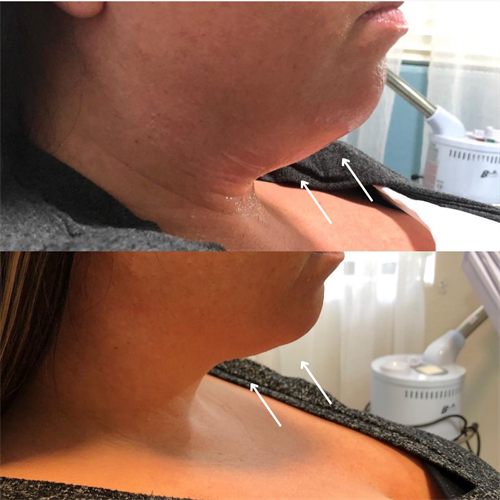 Before and After Kybella