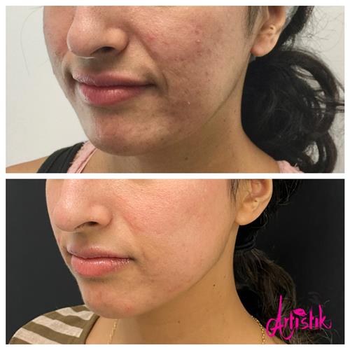 Before and After Morpheus8 for Acne