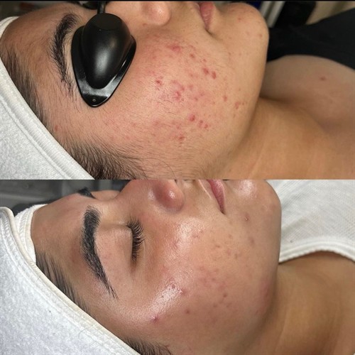 ProCell Microchanneling Before and After