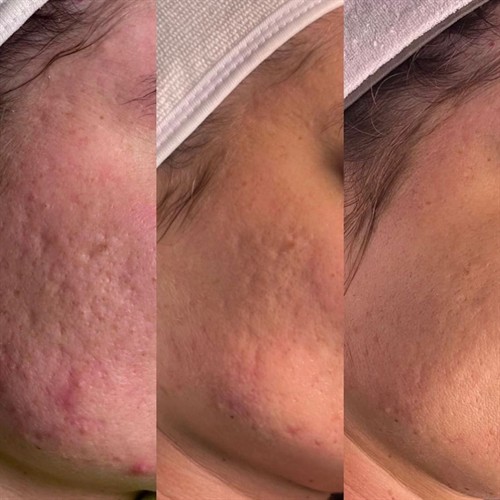 ProCell Microchanneling Before and After