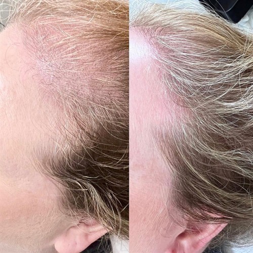 ProCell Microchanneling Before and After