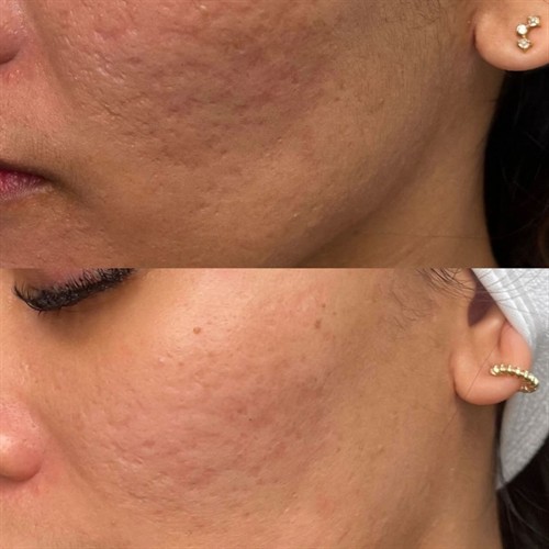 ProCell Microchanneling Before and After