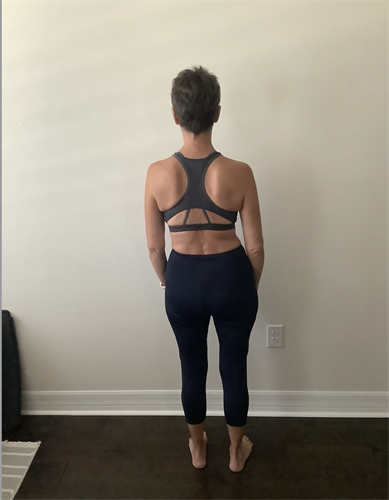 This "lateral offset"  is why physical therapy didn't fix her back pain