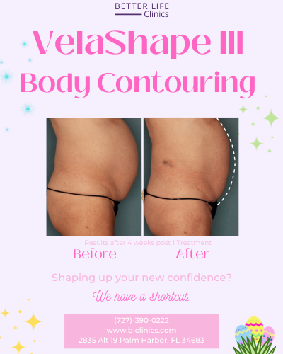 Enjoy %20 0ff Velashape III treatment for Body Contouring and Cellulite Reduction