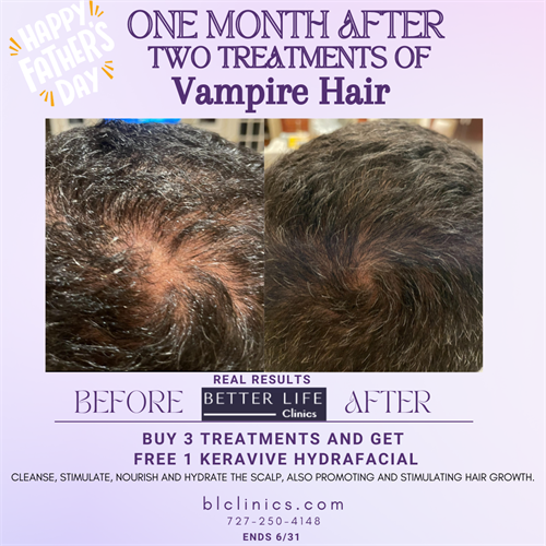 Happy Father`s Day! 'Vampire Hair' A Revolutionary Treatment Method for Hair Restoration, Using 'ZERO' Medications. We Spin Your Blood, Extract Platelets (A Specific Cell), and We Inject & Microneedle it in Your Scalp. Best if Accompanied with Keravive for Healthier Scalp.