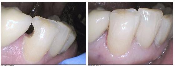 Composite Filling before and after