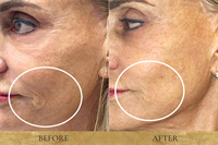 Non Surgical Face and Neck Lift