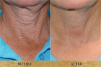 Non Surgical Neck Lift