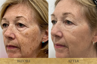 Brown Spots Laser