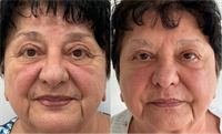 Under Eye Bag Correction +/- SkinTight & Clear