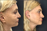 Non Surgical Face and Neck Lift