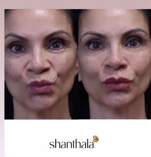 Lip Filler at ShanthalamD