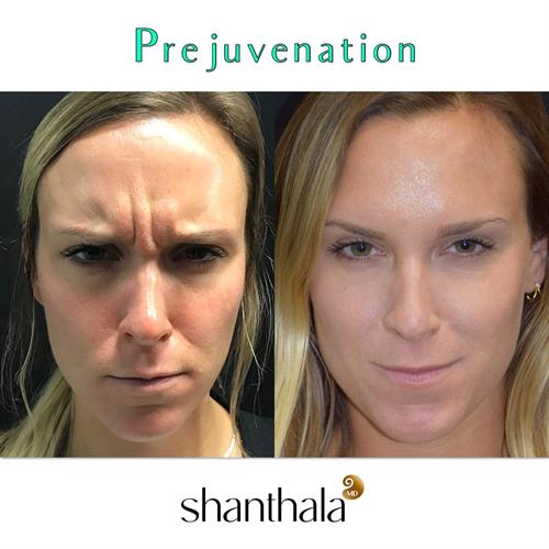 Botox Prejuvenation