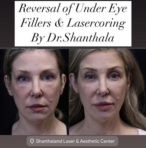 Under eye Fillers removal & LaserCoring