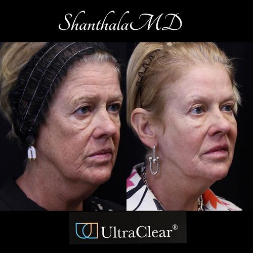 FULL FACE REJUVENATION BY DR.SHANTHALA