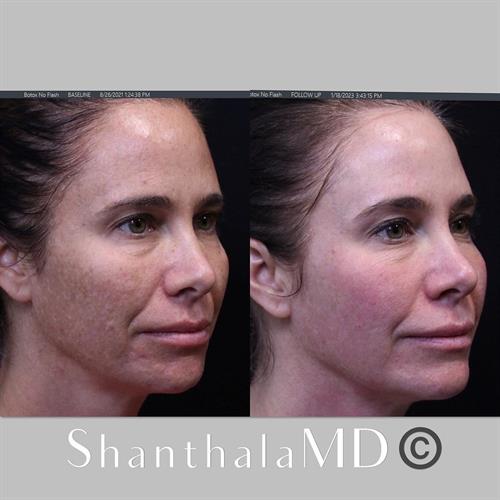 Non Ablative Laser Resurfacing