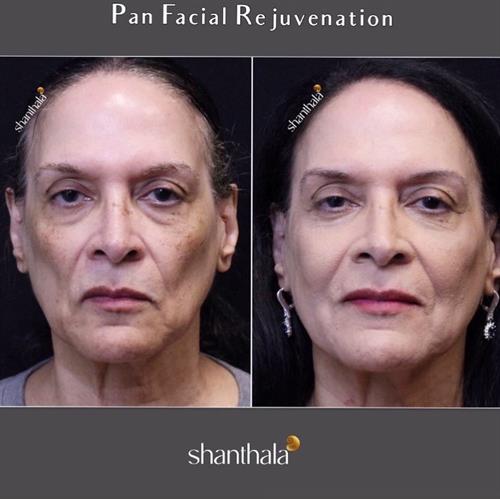 PAN FACIAL REJUVENATION BY DR.SHANTHALA