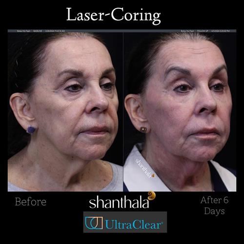 LASERCORING FULL FACE AND NECK WITH FACIAL VOLUME CORRECTION