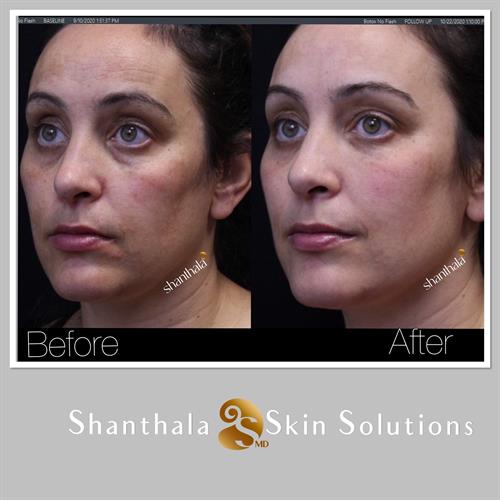 FRAXEL LASER RESURFACING BY DR.SHANTHALA