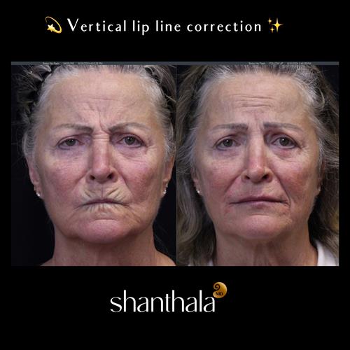 Vertical Lip lines Treatment at ShanthalaMD