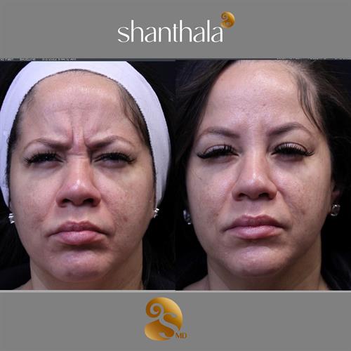 WRINKLE TREATMENT SHANTHALAMD