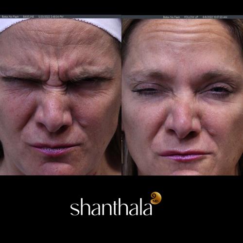 Botox by Dr. Shanthala